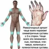 Артрит симптоми, лікування, опис (можуть привести розвитку) Артрит симптоми, лікування, опис