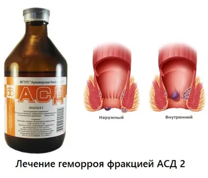 Асд фракція 2 при геморої лікування і відгуки (лікування) Асд фракція 2 при геморої лікування і відгуки