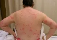 Білизняні клопи фото, як виглядають білизняні клопи, білизняні клопи як позбутися Дезцентр-русь (виглядають) Білизняні клопи фото, як виглядають білизняні клопи, білизняні клопи як позбутися Дезцентр-русь