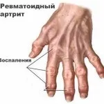 Болять суглоби пальців рук причини і лікування болю (пальців) Болять суглоби пальців рук причини і лікування болю