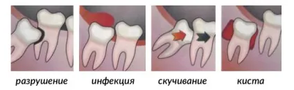 Болить зуб мудрості чому ниє ясна і як зняти біль (болить) Болить зуб мудрості чому ниє ясна і як зняти біль
