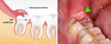 Болить зуб мудрості чому ниє ясна і як зняти біль (болить) Болить зуб мудрості чому ниє ясна і як зняти біль