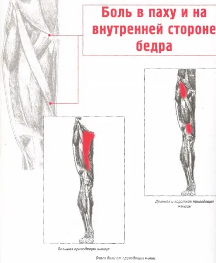 Біль в паху і на внутрішній стороні стегна (біль) Біль в паху і на внутрішній стороні стегна