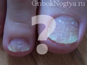 Чого боїться грибок нігтів на ногах (боїться) Чого боїться грибок нігтів на ногах