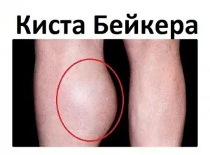 Розрив кісти Бейкера, кістаблог (розриву кісти Бейкера) Розрив кісти Бейкера, кістаблог