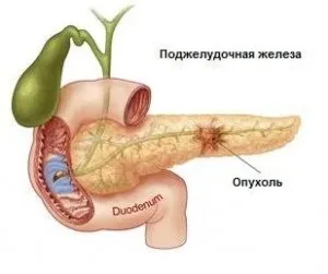 Рак підшлункової залози - симптоми і лікування (лікування) Рак підшлункової залози - симптоми і лікування