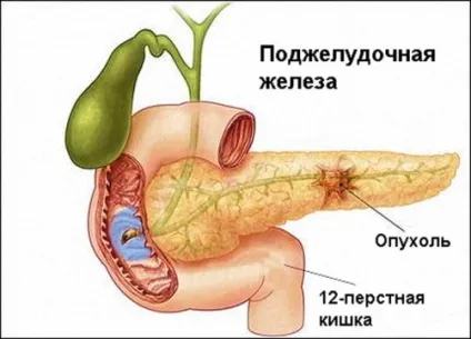 Рак підшлункової залози перші симптоми, ознаки та прояви (симптоми) Рак підшлункової залози перші симптоми, ознаки та прояви
