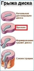 Що це пролапс міжхребцевого диска в поперековому відділі, лікування