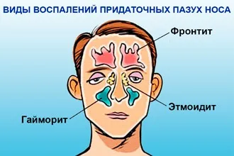 Що робити якщо болить голова при нежиті - причини і лікування (болить) Що робити якщо болить голова при нежиті - причини і лікування
