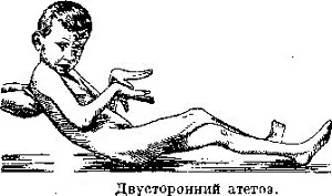 Що таке атетоз развновідності, симптомом ураження чого є атетозного гиперкинез) (є) Що таке атетоз развновідності, симптомом ураження чого є атетозного гиперкинез)