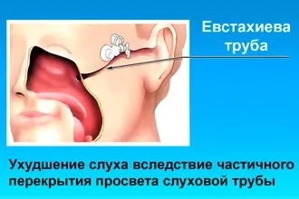 Що таке гиперпластический риніт - симптоми і лікування