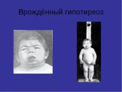 Що таке кретинізм хвороба або порушення з якихось причин виникає класифікація патології і (порушення) Що таке кретинізм хвороба або порушення з якихось причин виникає класифікація патології і