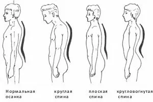 Що входить в лікування плоскої спини у дитини і у дорослого (плоскої) Що входить в лікування плоскої спини у дитини і у дорослого