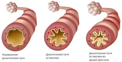 Що викликає астму і як розпізнати напад астми - алергія (напад) Що викликає астму і як розпізнати напад астми - алергія