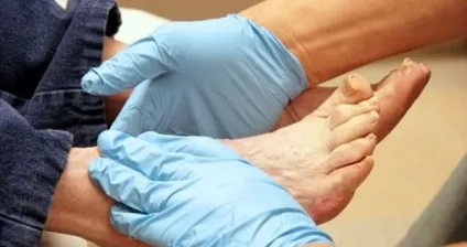 Що таке трофічна виразка гомілки або стопи, здорове життя (лікування народними засобами) Що таке трофічна виразка гомілки або стопи, здорове життя