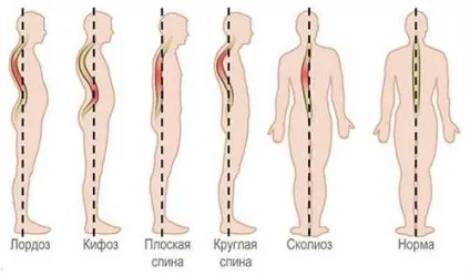 Що є головною причиною порушення постави і як впоратися з проблемою (причиною) Що є головною причиною порушення постави і як впоратися з проблемою