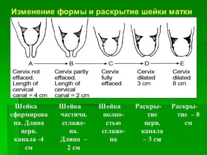 Що таке пессарий фото, навіщо при вагітності ставлять акушерський пессарий, показання та (ставлять) Що таке пессарий фото, навіщо при вагітності ставлять акушерський пессарий, показання та