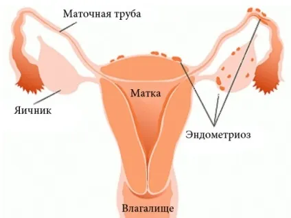 Що таке хронічний ендометріоз