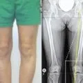 Деформуючий артроз причини, стадії, лікування захворювання