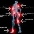 Деформуючий артроз причини, стадії, лікування захворювання