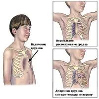 Деформації грудної клітки, центр Дикуля