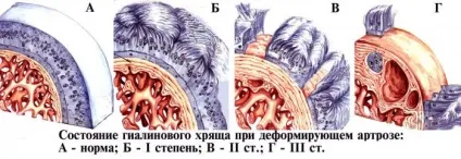 Деформуючий артроз причини, стадії, лікування захворювання