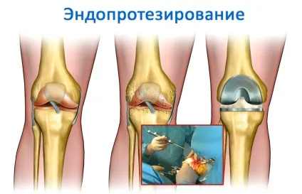 Деформуючий артроз причини, стадії, лікування захворювання