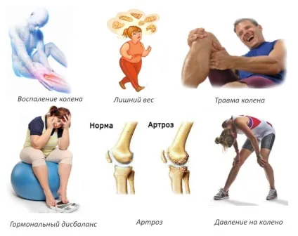 Деформуючий артроз причини, стадії, лікування захворювання