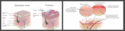 Дерматит - лікування, симптоми, причини і профілактика (лікування) Дерматит - лікування, симптоми, причини і профілактика