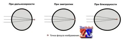 Дитяча далекозорість у дітей до року і 3 років (мінус або плюс) (дитяча) Дитяча далекозорість у дітей до року і 3 років (мінус або плюс)