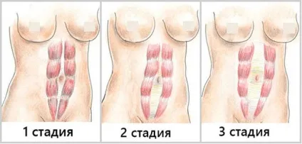 Діастаз після пологів що це, лікування розходження прямих м'язів живота після пологів (прямих) Діастаз після пологів що це, лікування розходження прямих м'язів живота після пологів