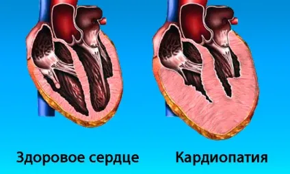 Диспластична кардиопатия у дітей і дорослих характеристика захворювання (диспластична) Диспластична кардиопатия у дітей і дорослих характеристика захворювання