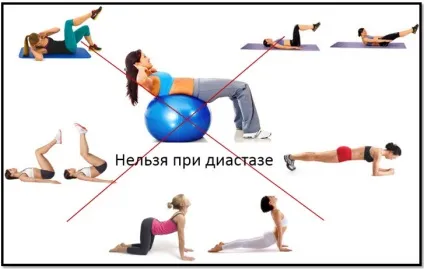Діастаз після пологів симптоми і лікування (передньої черевної стінки) Діастаз після пологів симптоми і лікування