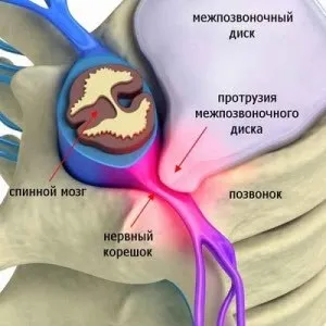 Дорзальная протрузія диска причини, симптоми, лікування, операція (лікування) Дорзальная протрузія диска причини, симптоми, лікування, операція