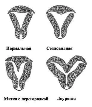 Дворога матка, сідлоподібна, з перегородкою причини виникнення, діагностика, метропластіка і