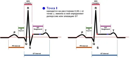 E-cardio елевацією сегмента st