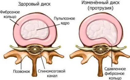 Дорзальная протрузія диска причини, симптоми, лікування, операція (дорзальная) Дорзальная протрузія диска причини, симптоми, лікування, операція