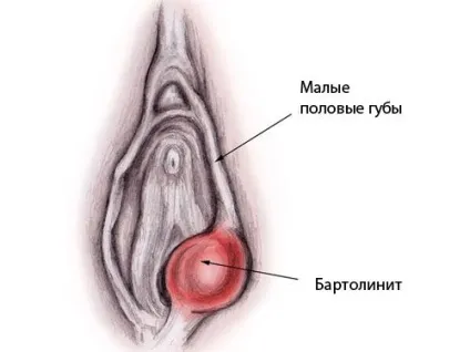 Дворога матка, сідлоподібна, з перегородкою причини виникнення, діагностика, метропластіка і