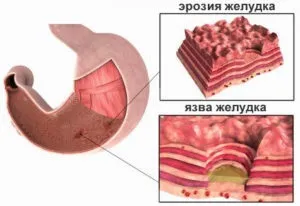 Ерозія шлунка симптоми, види, лікування і дієта (шлунка) Ерозія шлунка симптоми, види, лікування і дієта