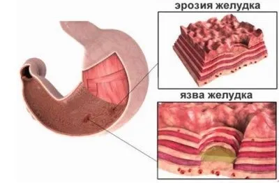 Ерозії антрального відділу шлунка поняття і способи лікування (відділу) Ерозії антрального відділу шлунка поняття і способи лікування