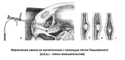 Ефективні методи лікування сечокам'яної хвороби без операції (лікування сечокам'яної хвороби) Ефективні методи лікування сечокам'яної хвороби без операції
