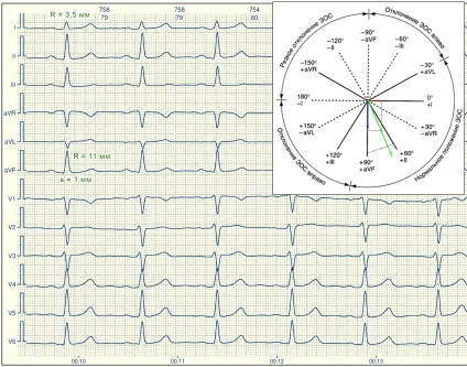 E-cardio урок 7 (електрична вісь)