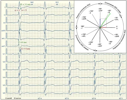 E-cardio урок 7 (електрична вісь)