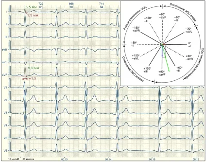 E-cardio урок 7 (електрична вісь)