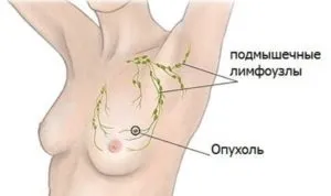 Фіброаденома молочної залози - причини і лікування (залози) Фіброаденома молочної залози - причини і лікування