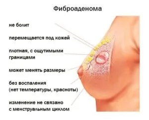 Фіброаденома молочної залози - причини і лікування (фіброаденома молочної залози) Фіброаденома молочної залози - причини і лікування
