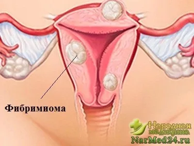 Фіброміома матки чи можливо лікування без операції, народні методи (фіброміома) Фіброміома матки чи можливо лікування без операції, народні методи