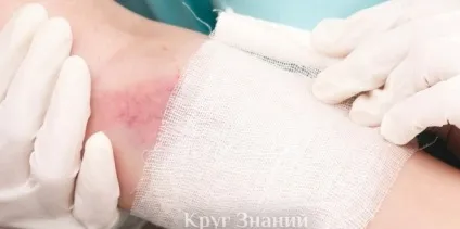 Флебіт - симптоми, причини виникнення, профілактика і лікування народними засобами - коло знань