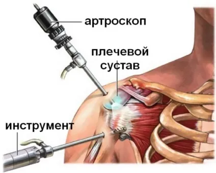 Генералізований остеоартроз - лікування, інвалідність