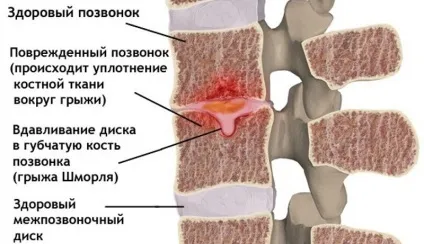 Грижа Шморля поперекового, грудного відділу хребта, що це таке, лікування (таке) Грижа Шморля поперекового, грудного відділу хребта, що це таке, лікування